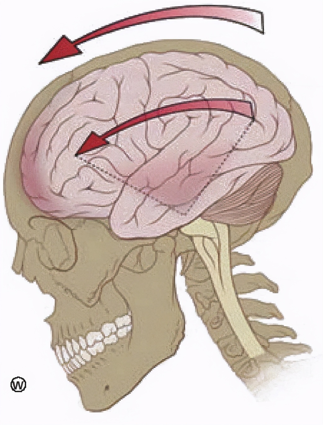 用头顶使劲撞墙会导致脑震荡么,自己用头撞墙会有脑震荡么