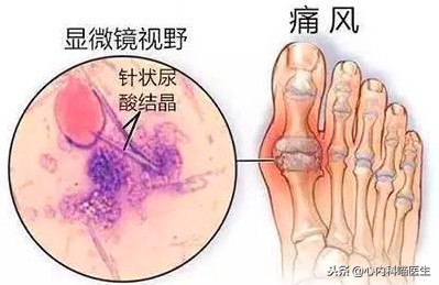 阿托伐他汀钙片降血脂降尿酸,阿托伐他汀和瑞舒伐他汀哪个升尿酸