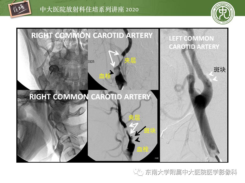 颈动脉夹层的超声表现及漏诊分析,动脉夹层与夹层动脉瘤是一样的吗