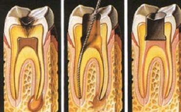 用于牙痛的消炎镇痛药有哪些,止痛药对牙痛有效吗