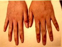 吃药身上起药疹怎么办还要吃吗,吃药一周后身上起疹子是药疹