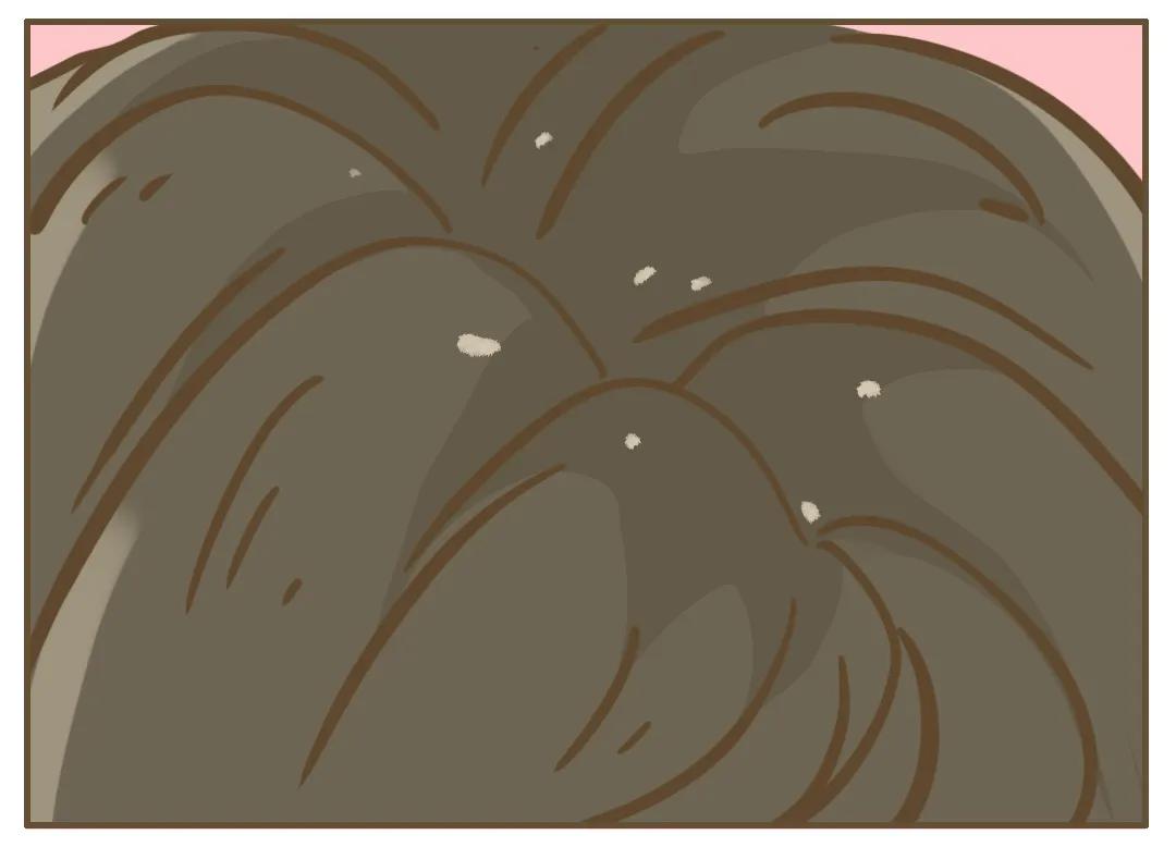 冬天为什么会有头皮屑,为什么头皮屑越挠越多