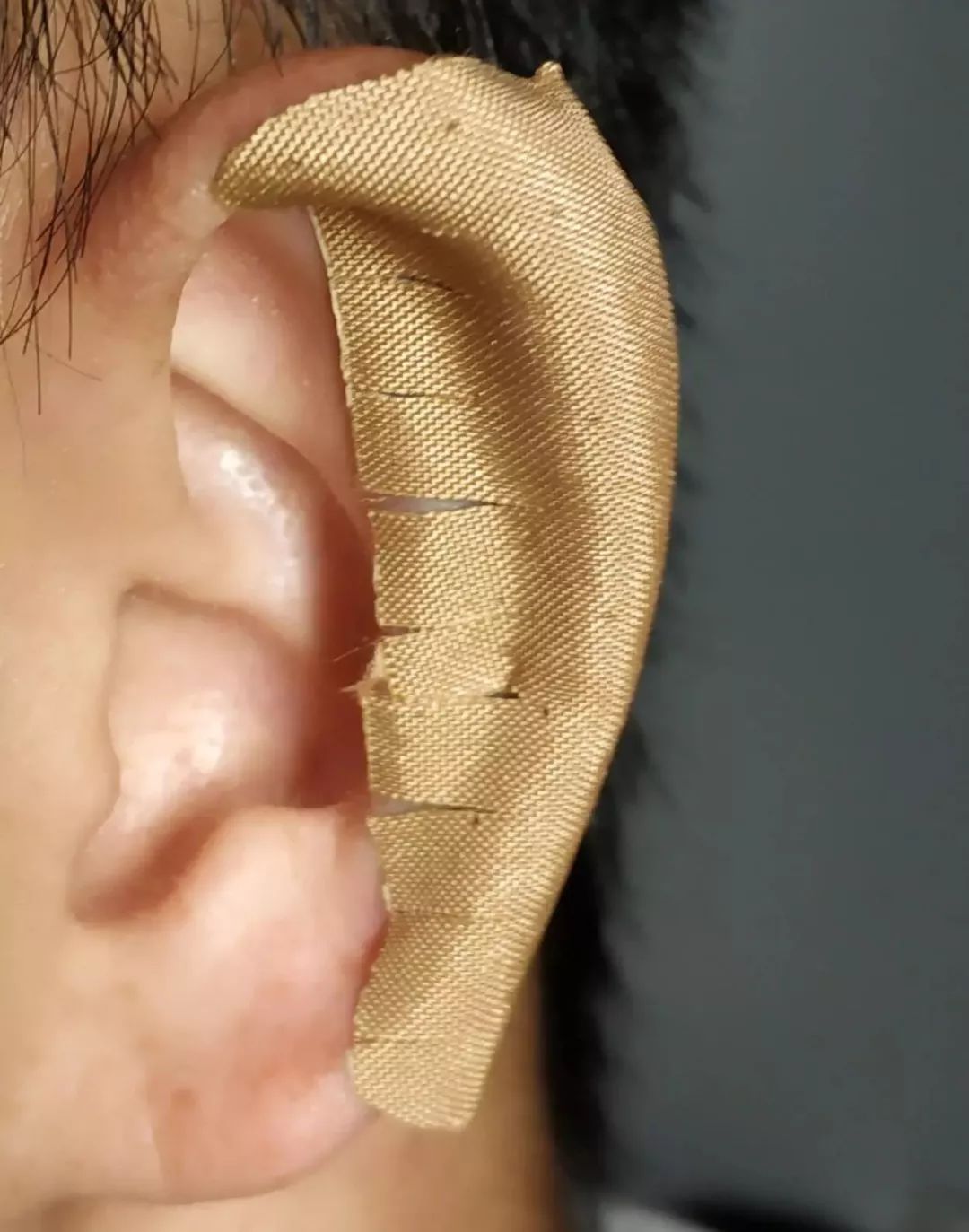 特殊敷料敷贴,手术缝合口粘贴敷料使用方法