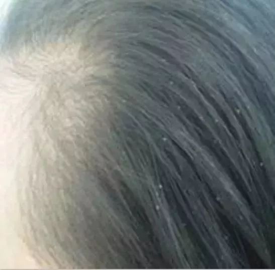 12岁女孩头皮屑多到吓人！竟是这个习惯导致的！