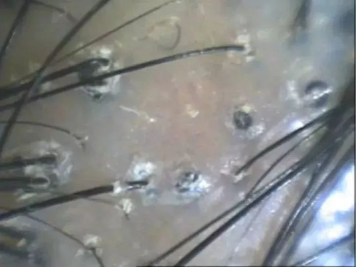 12岁女孩头皮屑多到吓人！竟是这个习惯导致的！