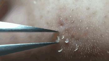 辣眼睛，有人用它吸出一整年的黑头，看完我果断下单了！