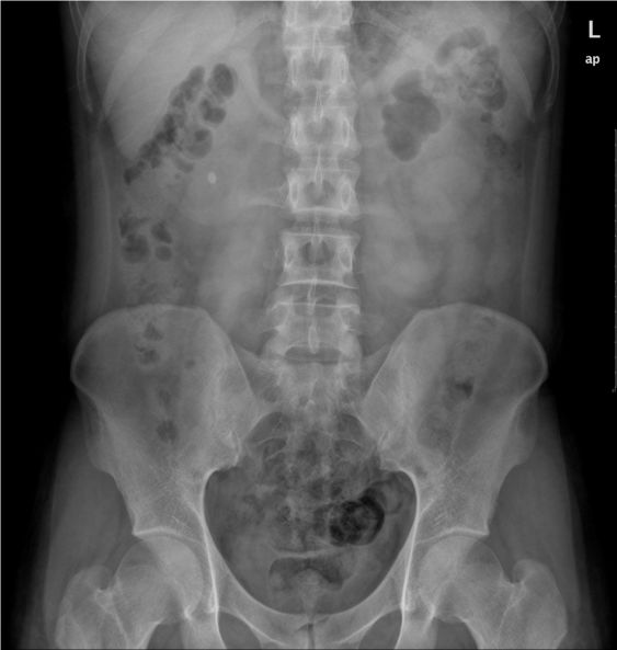 急诊科常见急腹症观察,腹部急诊影像大全值得收藏