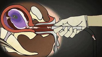 多次打胎真实案例,25岁女生接受多少次打胎