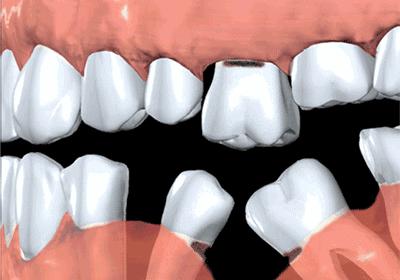 全城征集免费种植牙,全城征集免费种牙