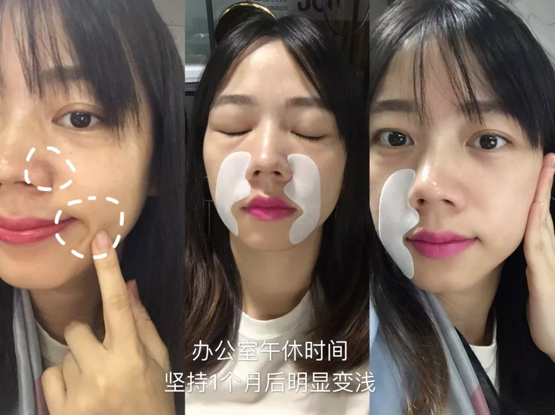 法令纹会让自己显老5到10岁,法令纹显老十岁教你解决