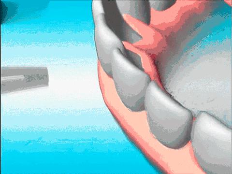 男子被查梅毒后续,一般男性得了梅毒几率有多大