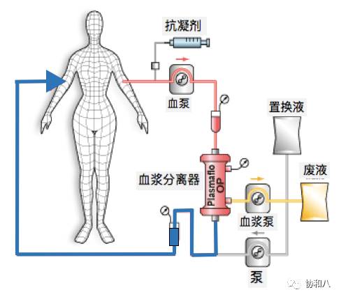 血浆置换和血透区别,血浆置换和血透的区别是什么