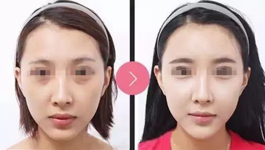 玻尿酸一打就是个无底洞,打玻尿酸现在是不是还挺普遍的