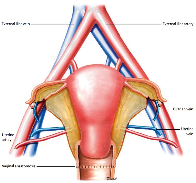 柳叶刀人造子宫,柳叶刀移植