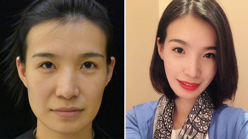 法令纹的细纹去除最好的方法,怎么补救法令纹上的细纹