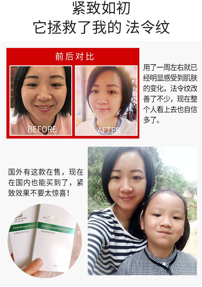 法令纹的细纹去除最好的方法,怎么补救法令纹上的细纹