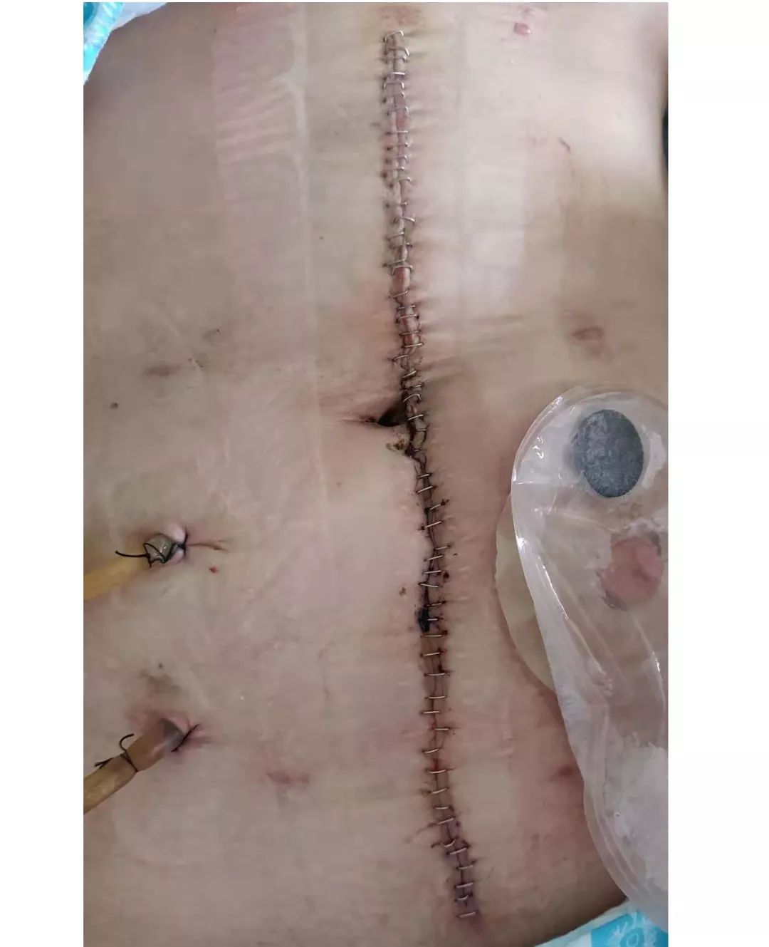 看，这30公分的手术切口，订满了钉子，要不这么作，她好不了这么快！