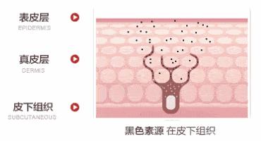 5个祛斑小妙招淡化晒斑雀斑痘印,痘印晒斑和疤痕用什么产品比较好