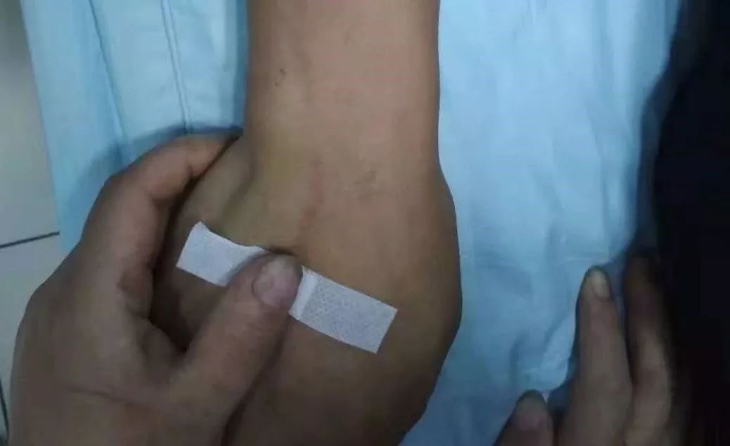 手臂输液后静脉炎怎么办,输液手臂出现索状红线