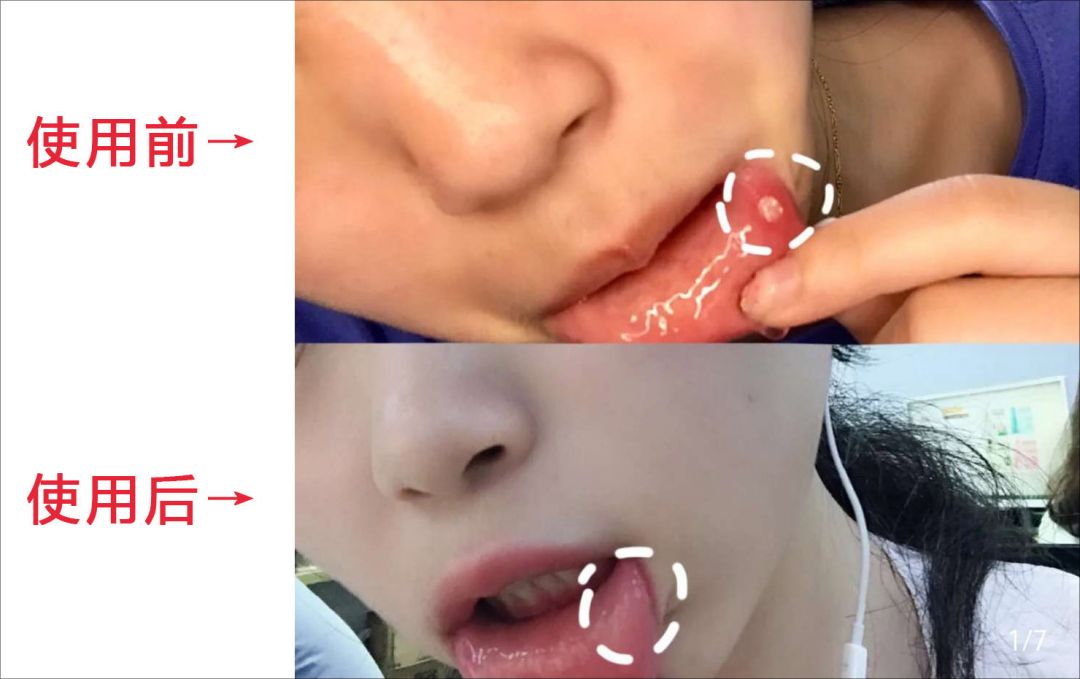 口腔溃疡反复发作吃什么容易愈合,口腔溃疡一抹止痛