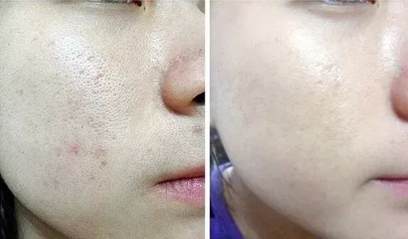 拨黑头工具草莓鼻,去黑头神器真的能吸出黑头