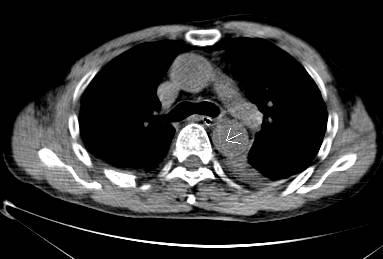 没有cta这三招也能识别主动脉夹层,磁共振可以替代cta检查主动脉夹层