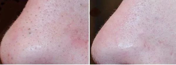 蜂蜜加白醋怎么使用效果好,蜂蜜加白醋的吃法一定要知道