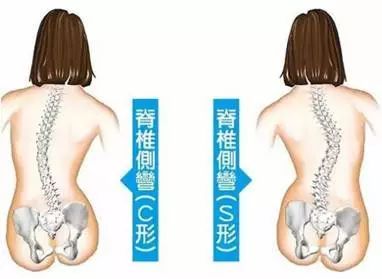 父母必看系列青少年心理健康,家长发现脊柱侧弯