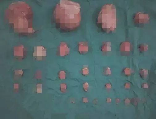 未婚女子形似怀孕7个月，医生发现她肚子里密密麻麻……