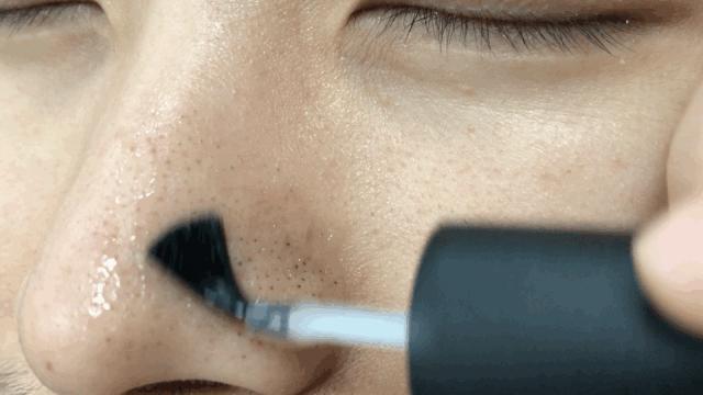 白头黑头到底拔不拔,黑头反反复复如何根治