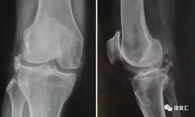 膝关节不同部位疼痛的病因分析,膝关节疼痛的十大原因及治疗