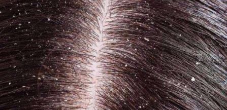 头上头皮屑和剪发虫怎么解决,头皮屑多和肚子里有虫有关系吗