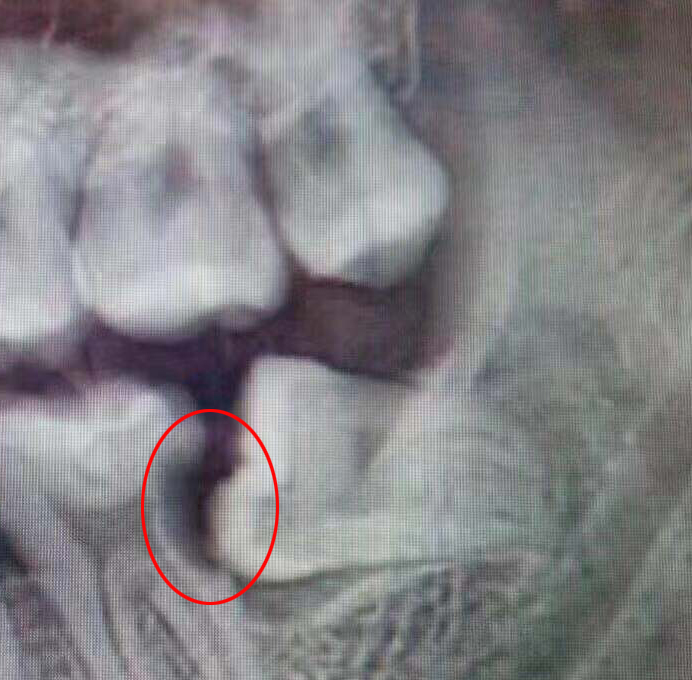 智齿发炎可以不拔吗,智齿都拔了牙龈还发炎怎么办