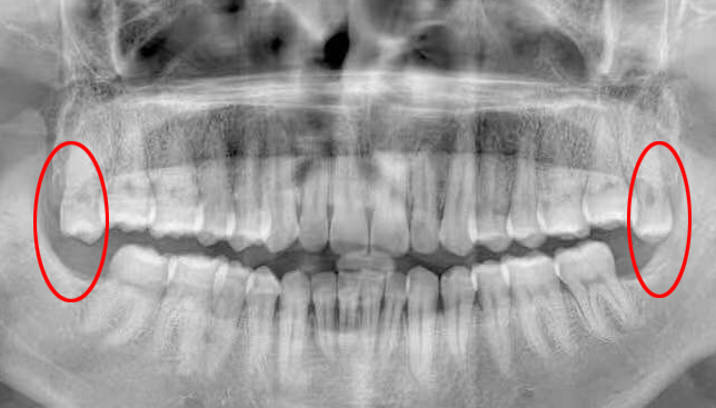 智齿发炎可以不拔吗,智齿都拔了牙龈还发炎怎么办