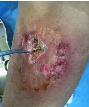 一般药物外渗的表现及处理方法,药物外渗多久会有反应