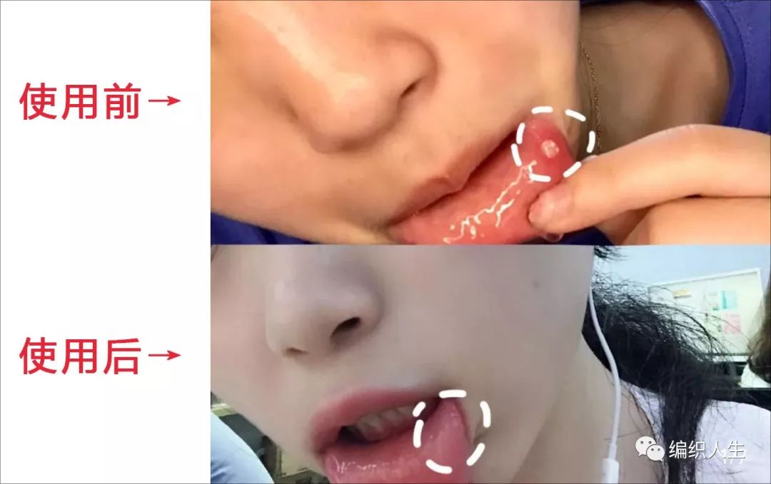 复发性口腔溃疡的特效药,治疗口腔溃疡一个药片就能搞定