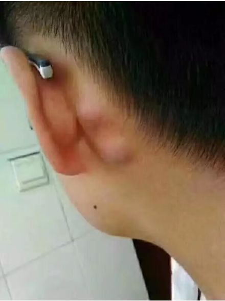 幼儿耳后鼓包怎么回事,你的耳后有鼓包吗