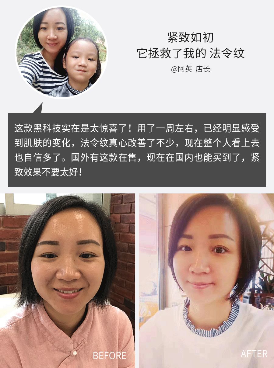 杨紫法令纹填充过多像小猴子,杨紫法令纹和嘴角纹怎么这么深
