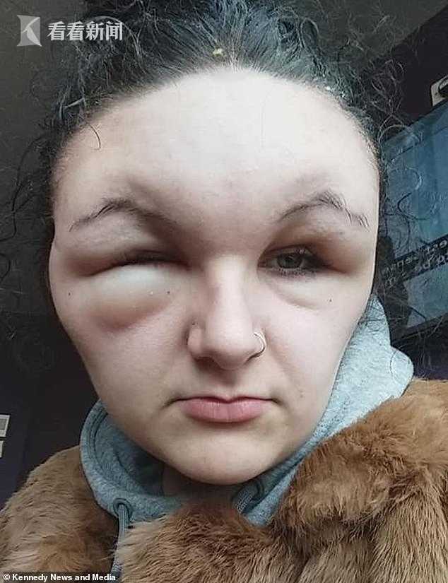 18岁女子染发剂过敏脸肿大一倍像“怪物”眼睛两天睁不开