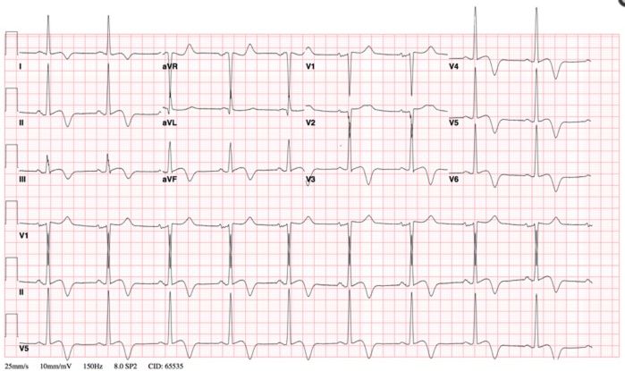 心尖部肥厚型心肌病心电图表现,心尖肥厚型心肌病心电图