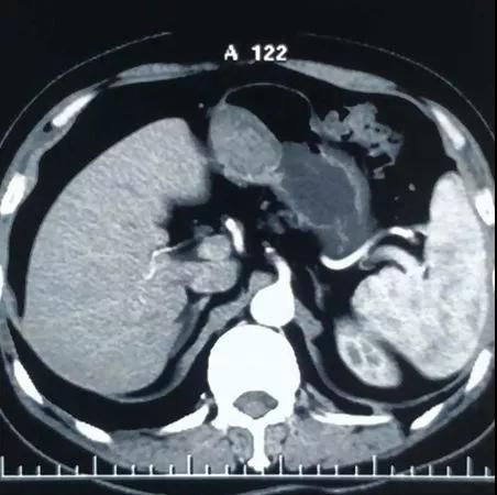 土豆大的肿瘤有多大,土豆大的肿瘤