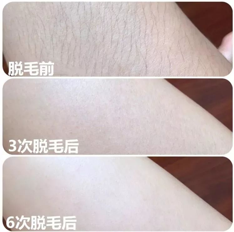 女士永久脱毛推荐排行榜第一名,美容永久脱毛抖音团购