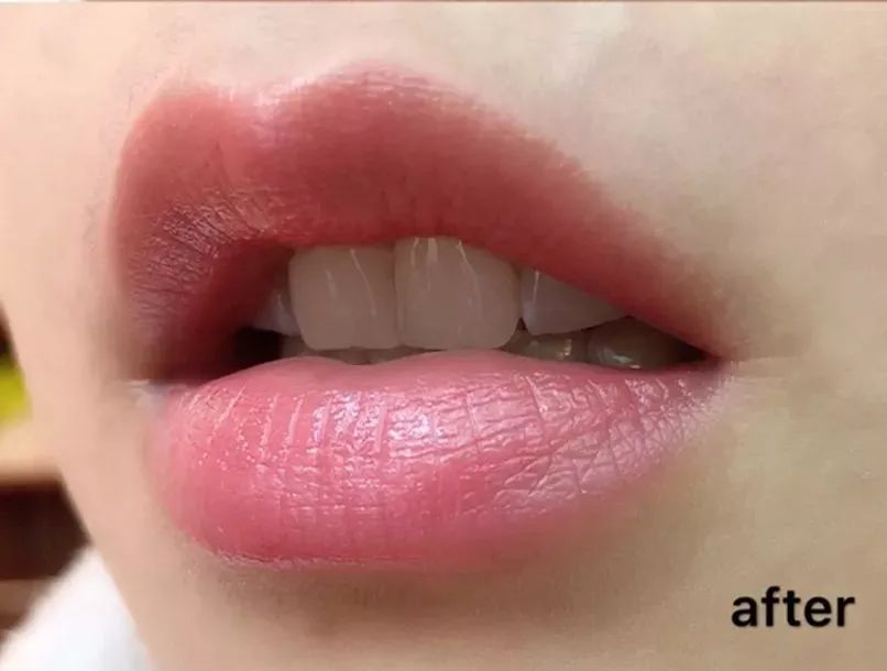 女士永久脱毛推荐排行榜第一名,美容永久脱毛抖音团购