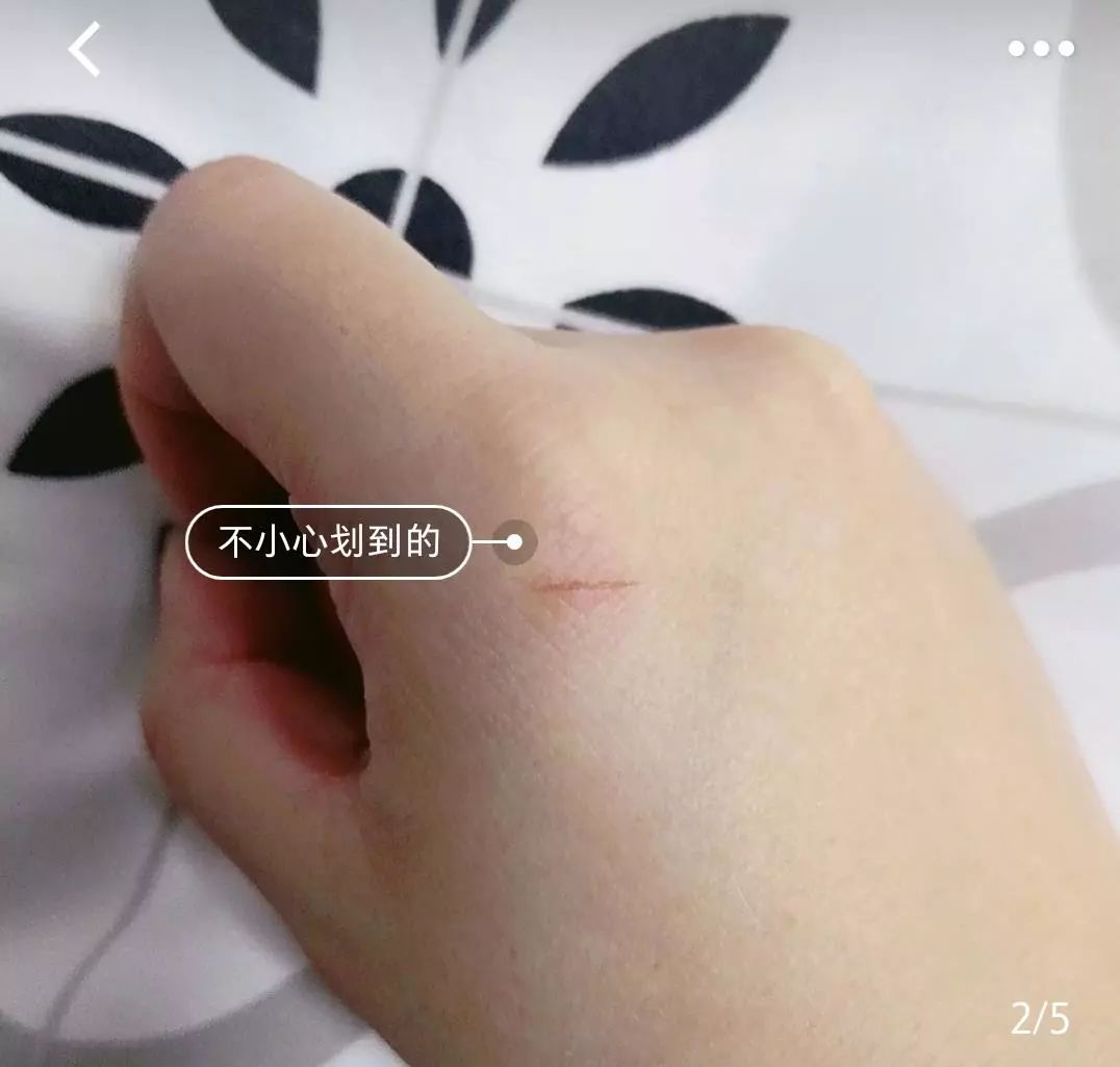 疤痕体质如何去痘印和烫伤印,烫伤色素疤痕修复的最新方法