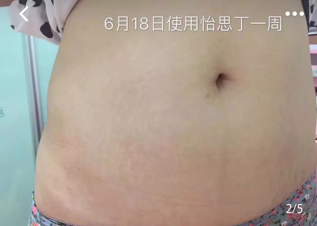 疤痕体质如何去痘印和烫伤印,烫伤色素疤痕修复的最新方法