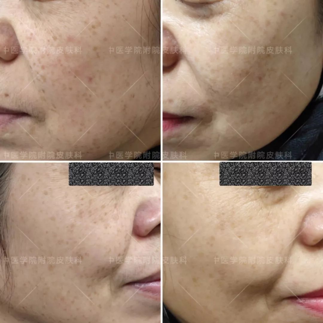 光子嫩肤优惠活动,医院光子嫩肤打特价