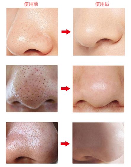 辣眼睛，有人用它吸出一整年的黑头，看完我果断下单了！