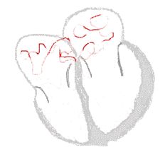 专家谈房颤怎么治疗,专家讲房颤治疗方法