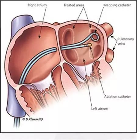专家谈房颤怎么治疗,专家讲房颤治疗方法