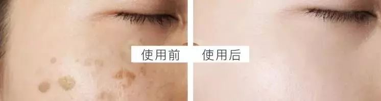 5个祛斑小妙招淡化晒斑雀斑痘印,痘印晒斑和疤痕用什么产品比较好